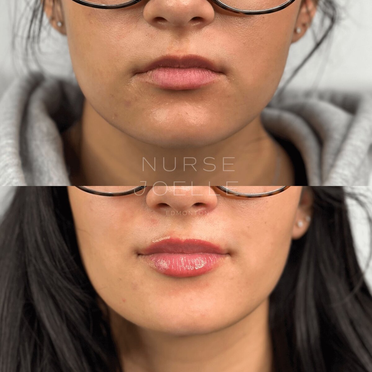 Nurse-Joelle-Cosmetic-Injectables-Before-and-After-4