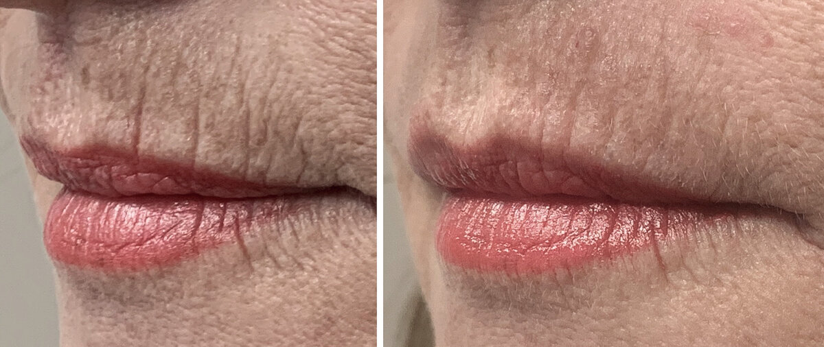 Lipfillers Rotterdam cosmetisch arts Lizenka Adriaanse