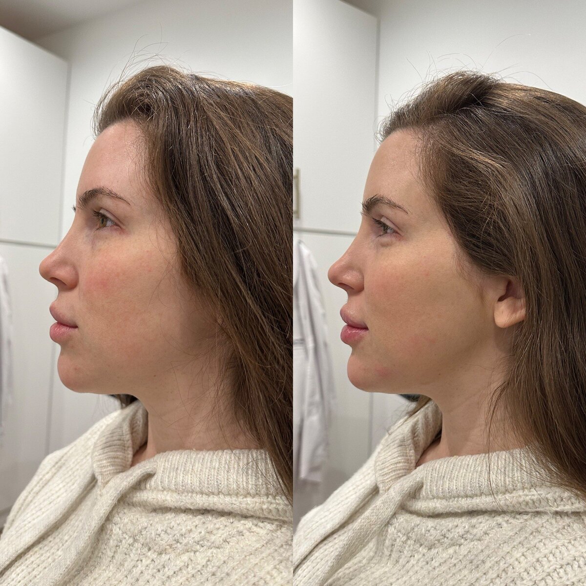 canova-aesthetics-med-spa-before-after-injectables-9