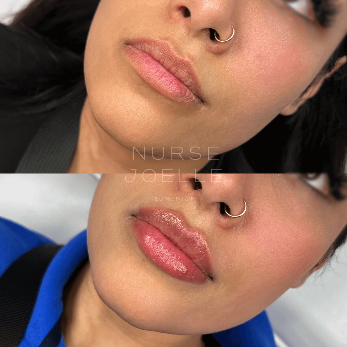 Nurse-Joelle-Cosmetic-Injectables-Before-and-After-9