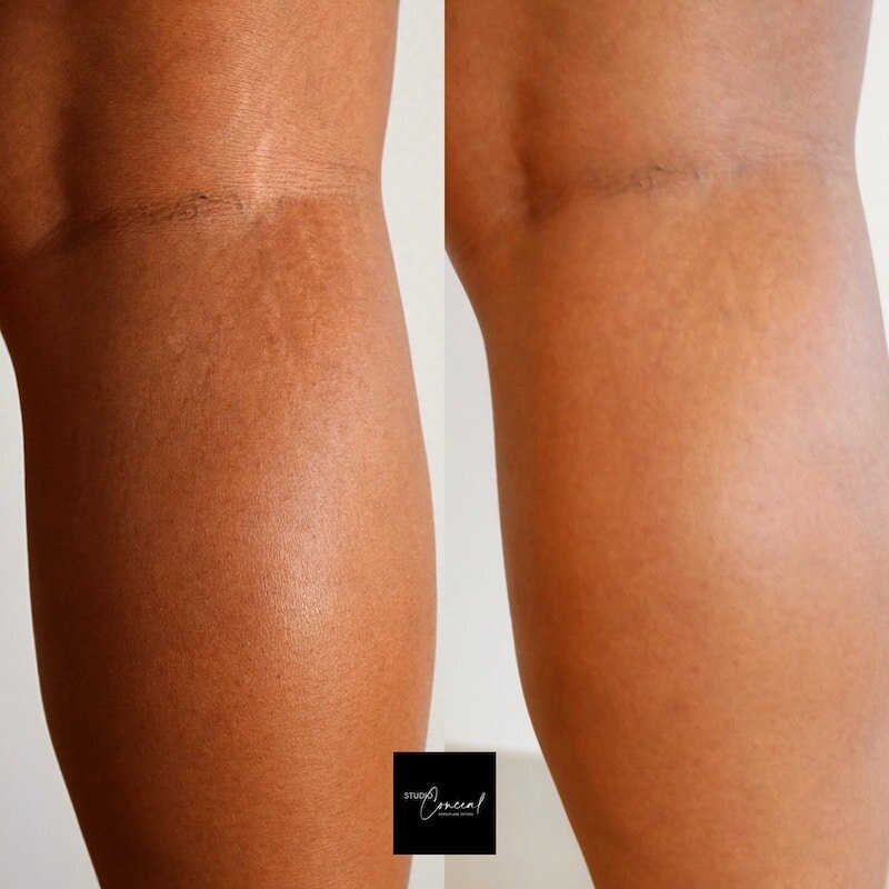 african-american-stretch-mark-removal