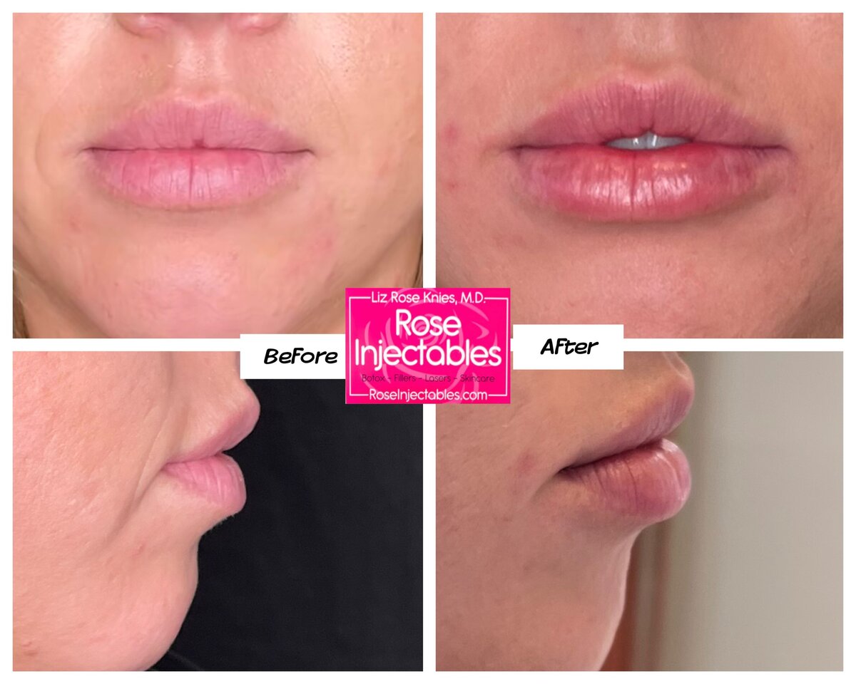 Fillers-by-Rose-Injectables-Before-and-After-Photos-27