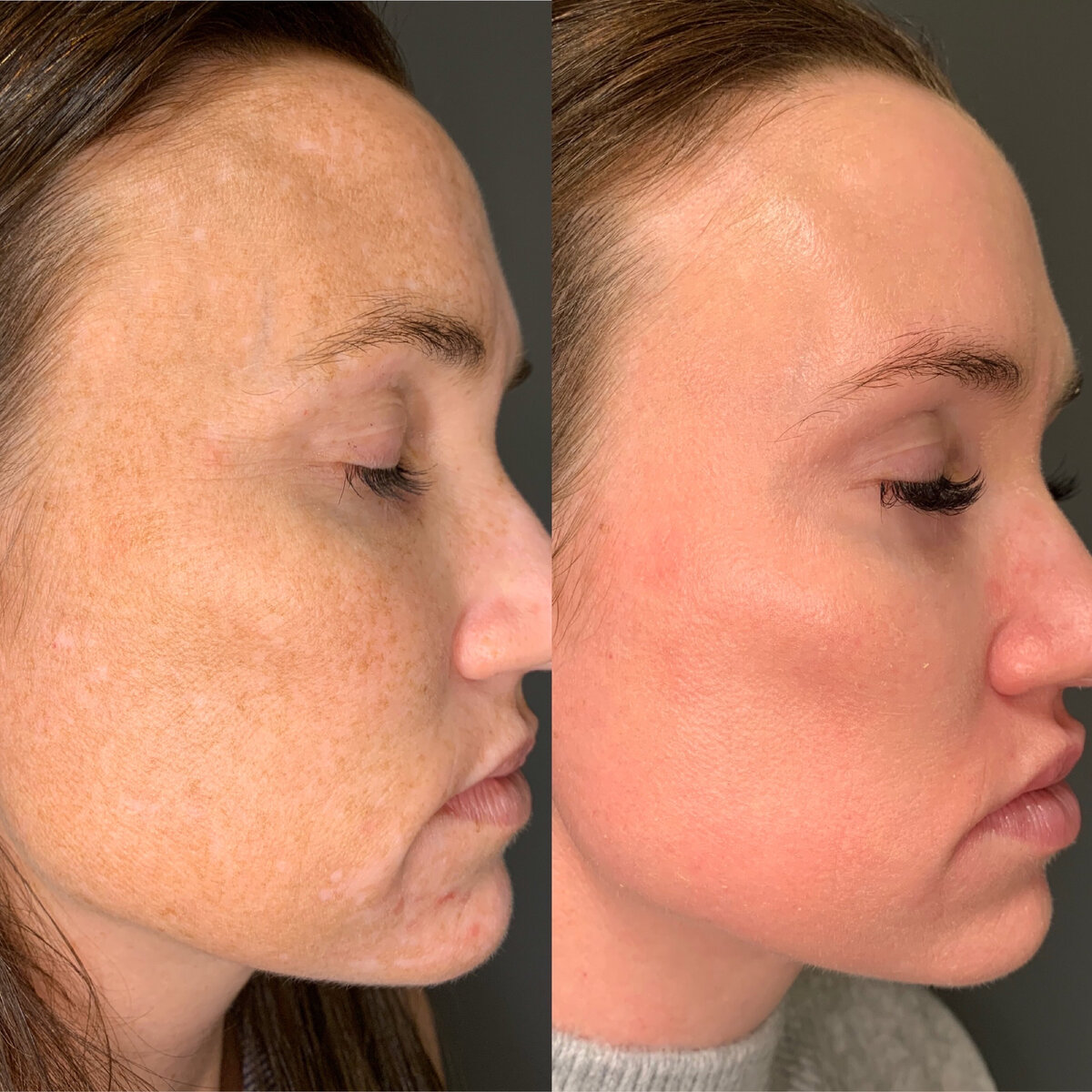 MELASMA PATIENTS-04