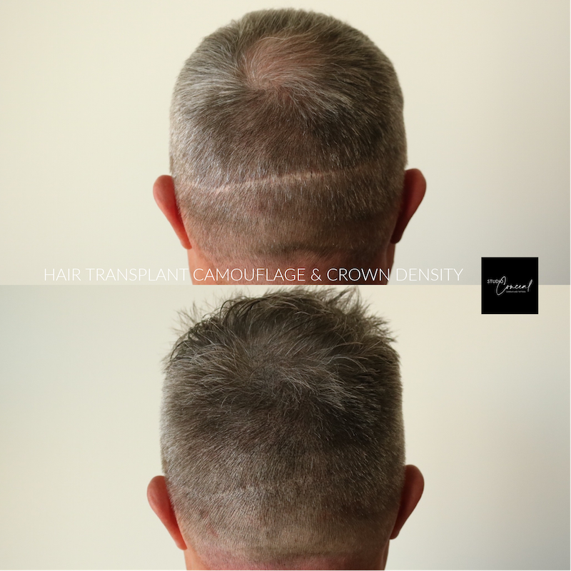 Hair-Loss-Density-Tattoo-2