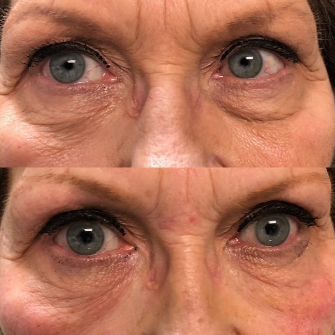 Under eye filler with a blunt cannula technique