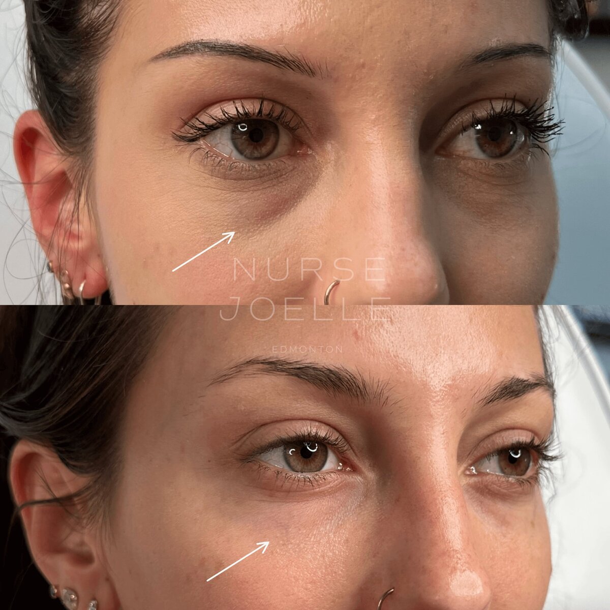 Nurse-Joelle-Cosmetic-Injectables-Before-and-After-3