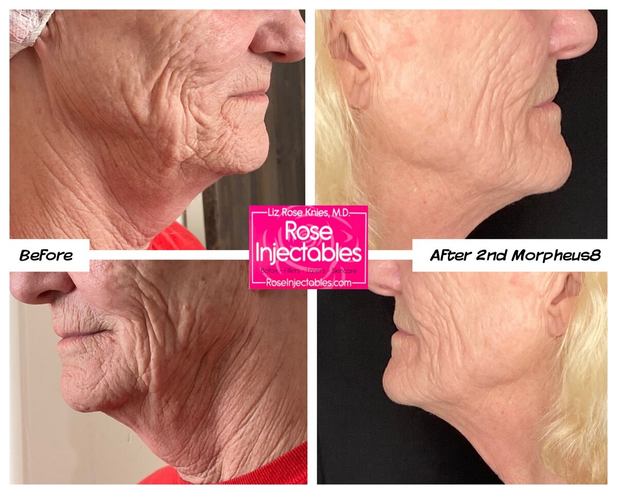 Morpheus8-by-Rose-Injectables-Before-and-After-Photos-51