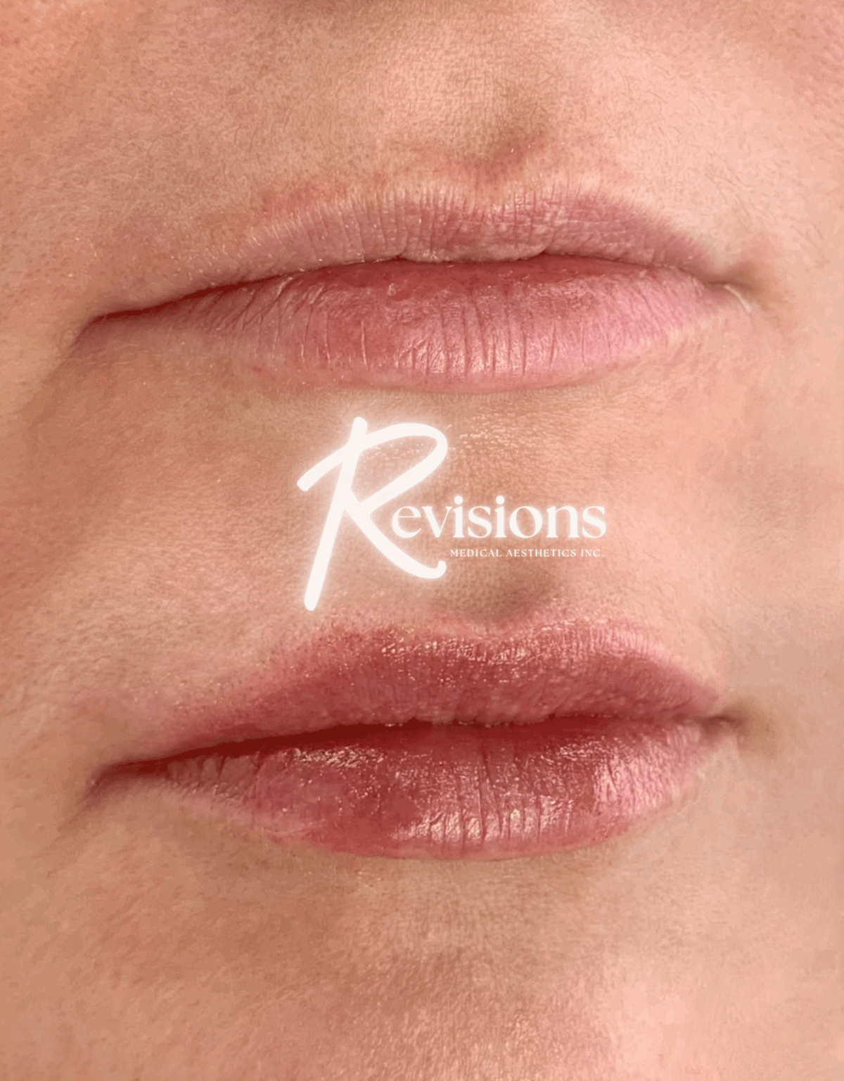 Best_Lip_Filler_Injector_in_Ottawa (1)