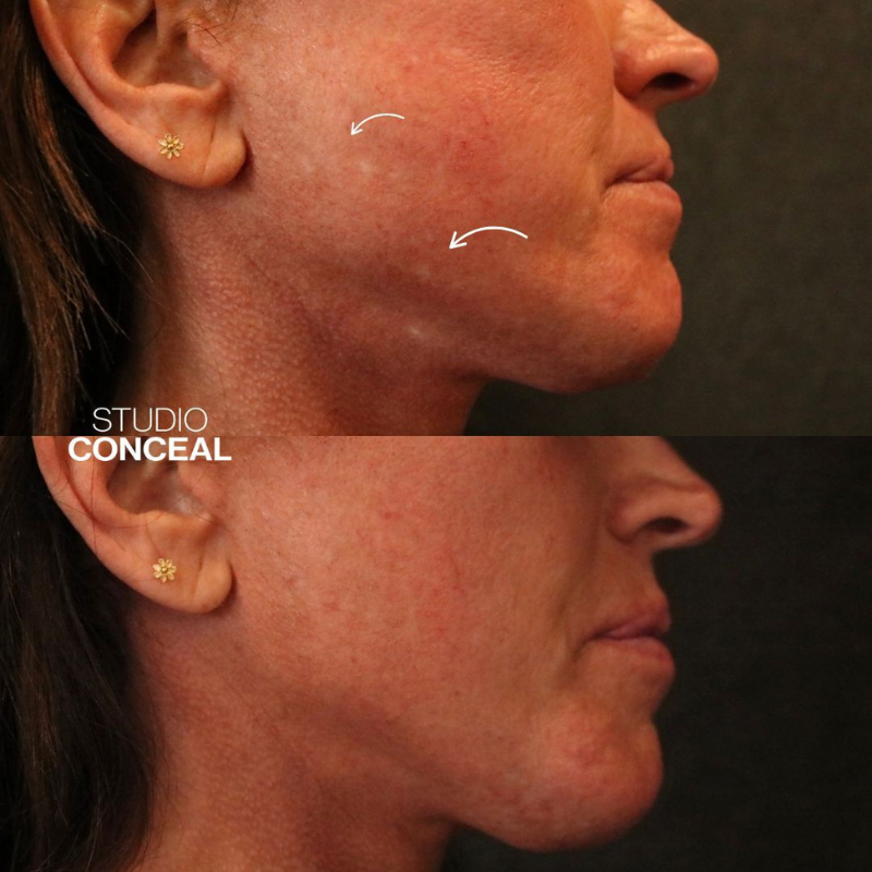  acne scar revision tattoo