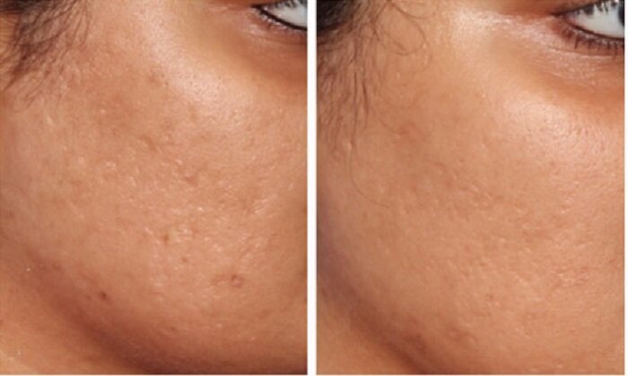 micropen-microneedling-before-and-after-3