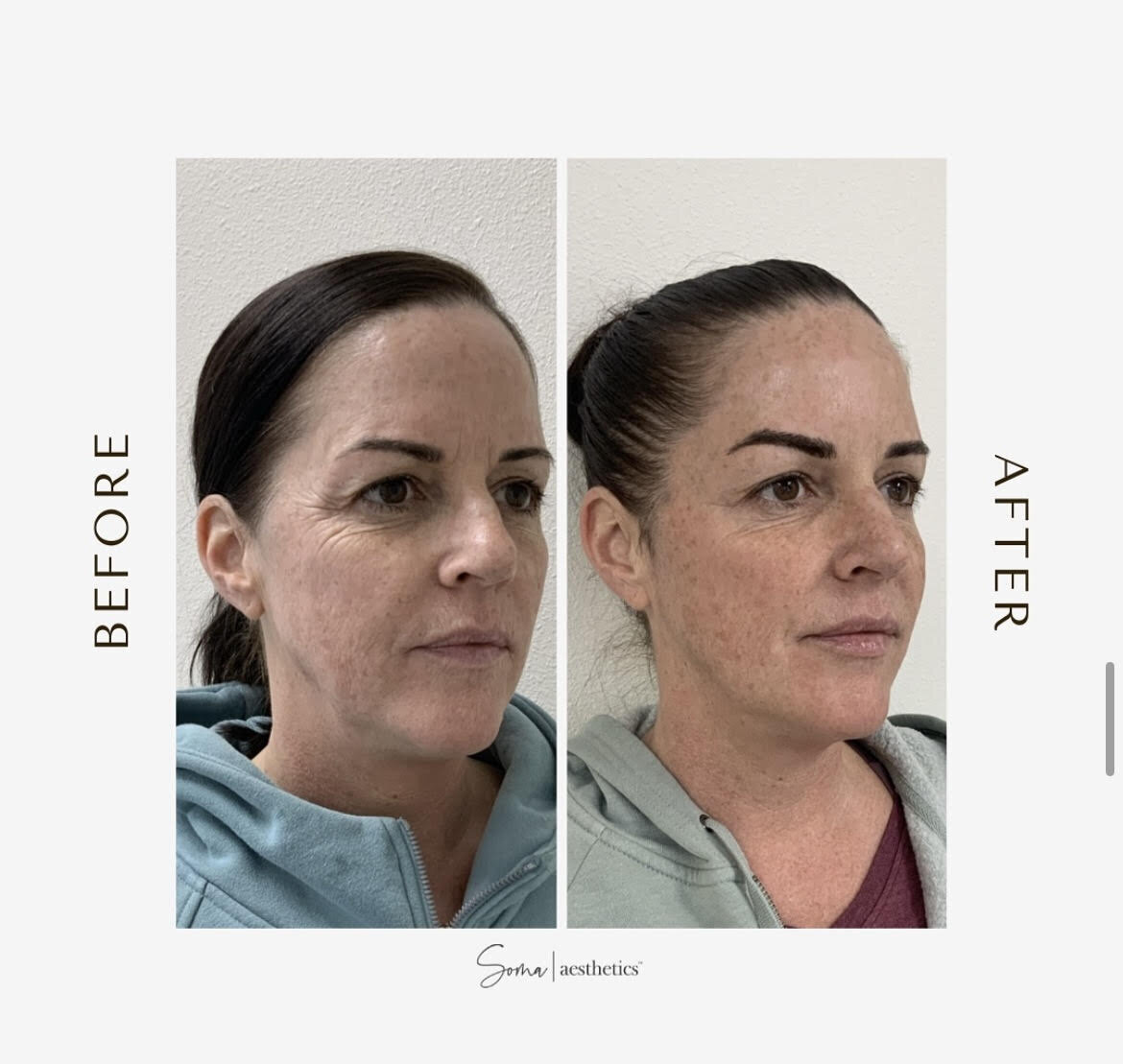 Sculptra + Botox 