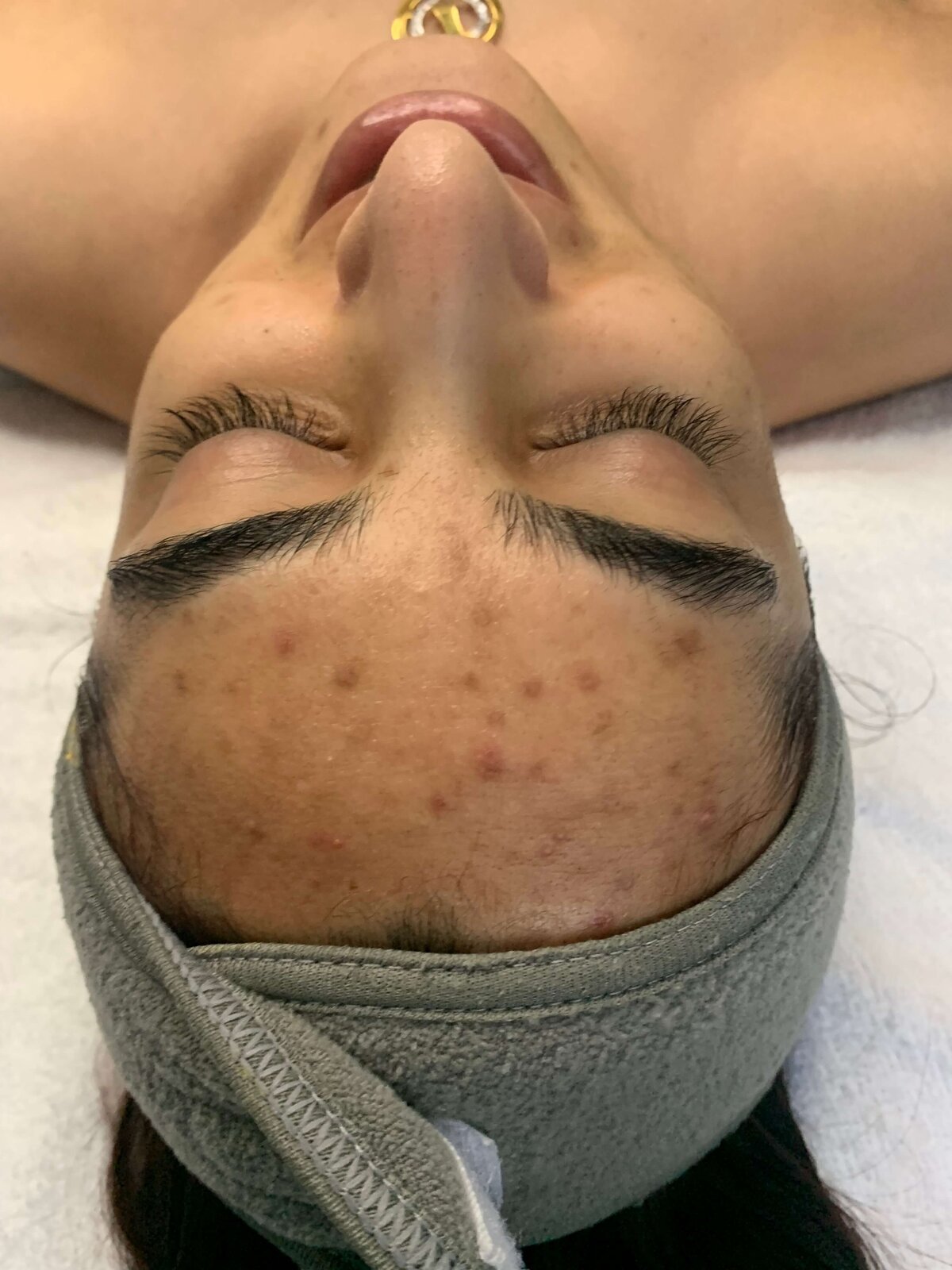 Santa-Barbara-Acne-Specialist_1639