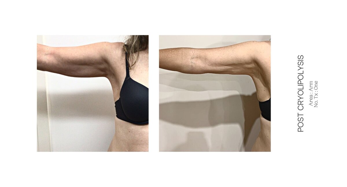 Cryolipolysis Arms Before and After 2