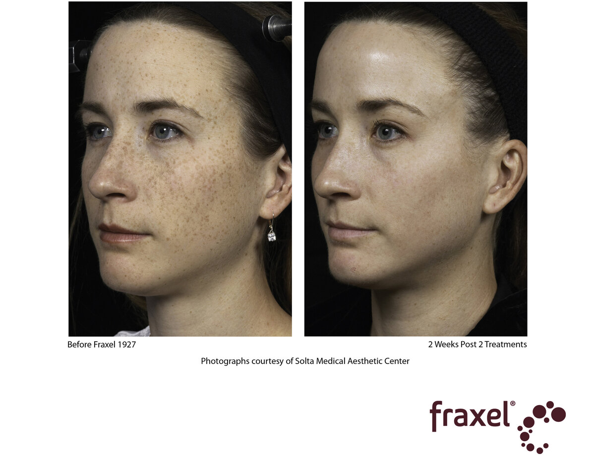 0139-Fraxel_1927_HiRes