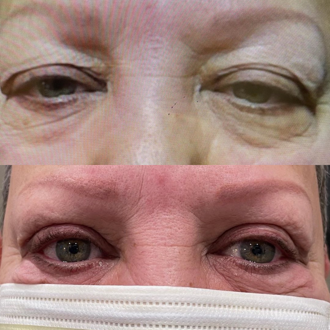 Lacrimal gland repositioning