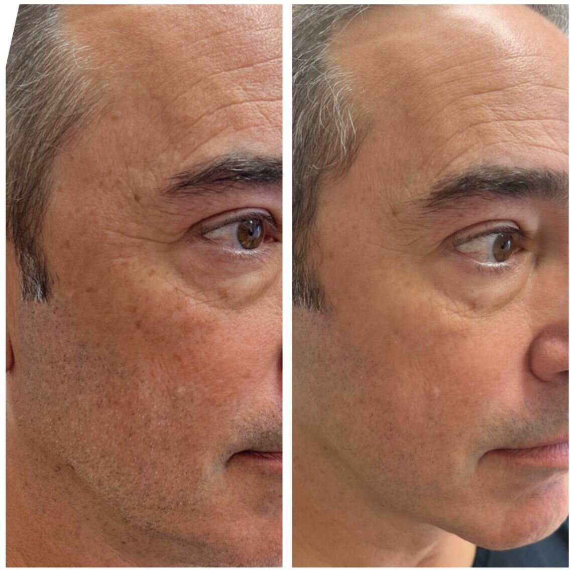 bbl-before-after-09
