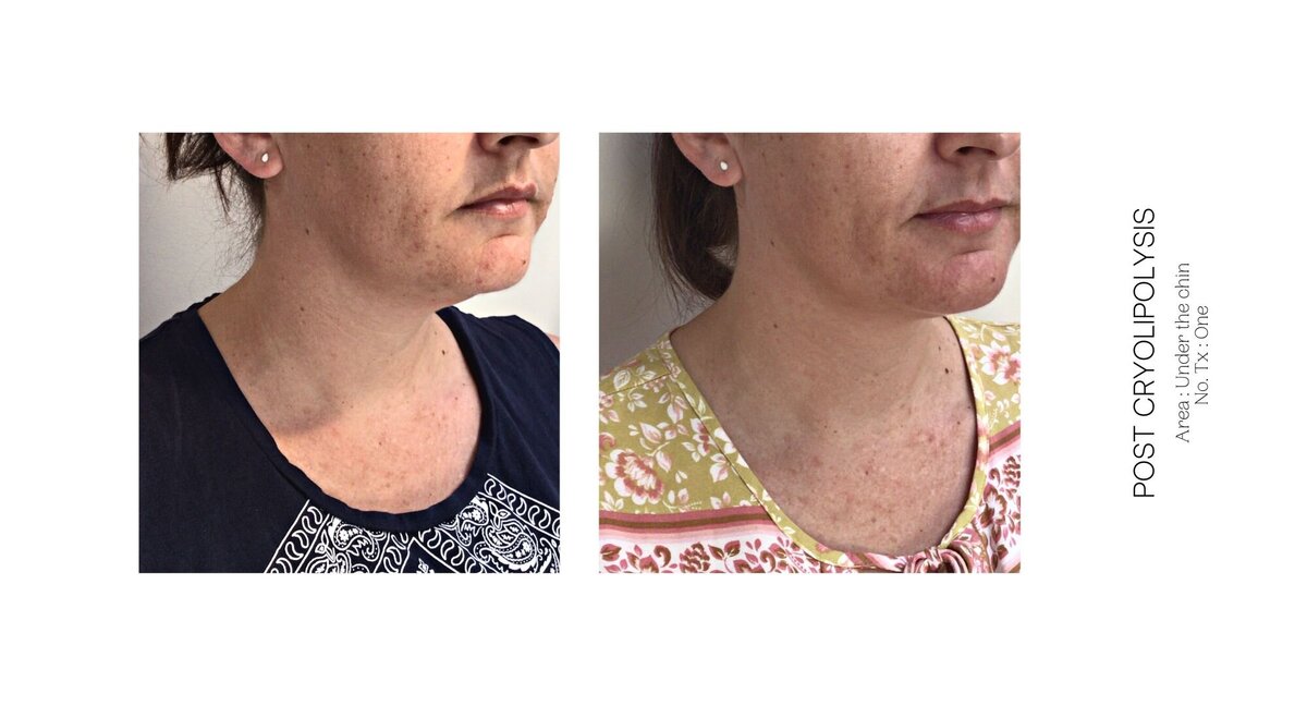 Cryolipolysis Chin Before and After 2
