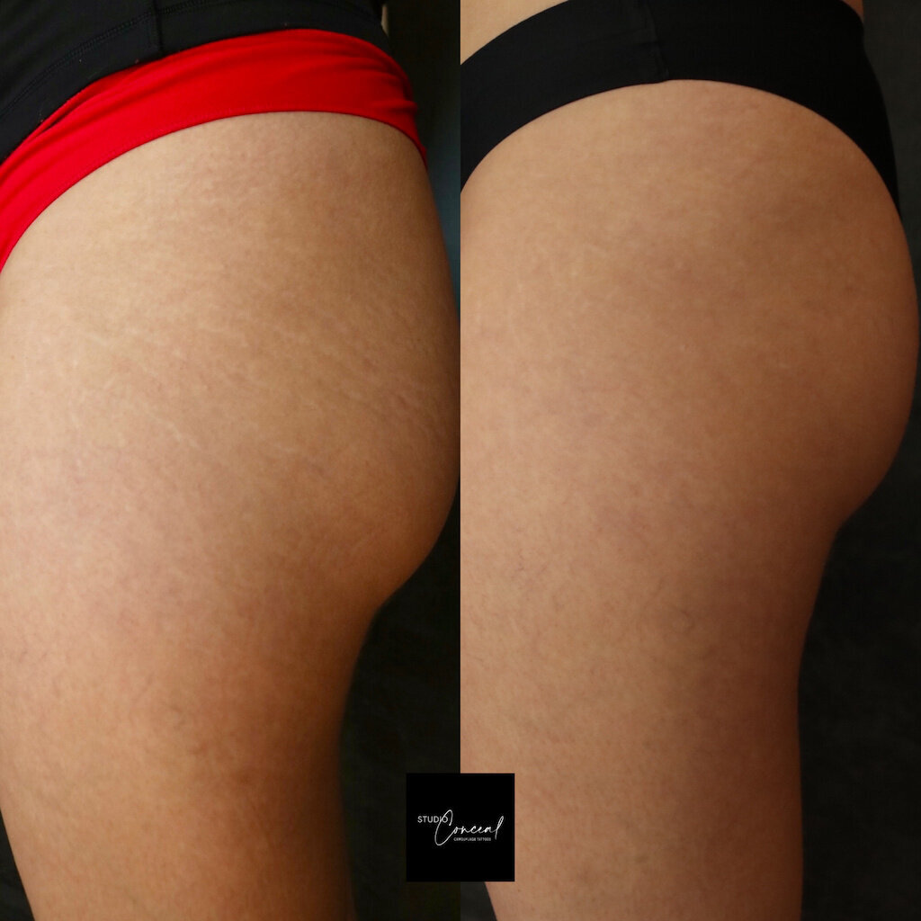 stretch-mark-rejuvenation