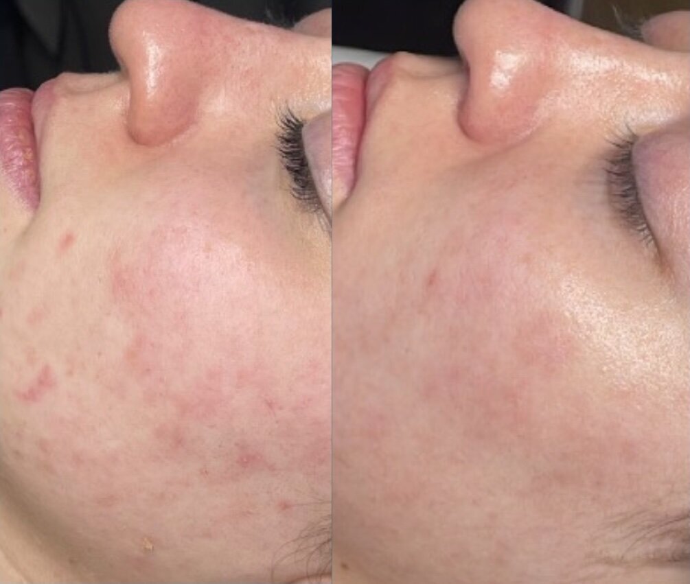 Microneedling before and after 3