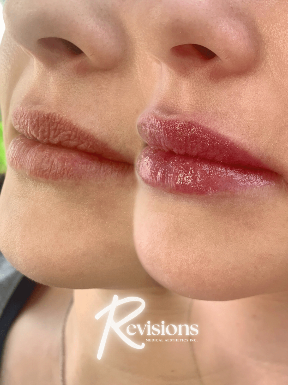 Lip_Filler_Nurse_Injector_in_Ottawa (1)