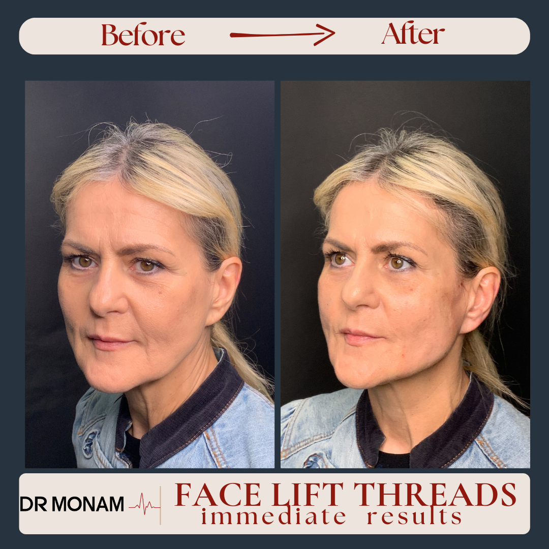 Neutral Before and After Instagram Post-24