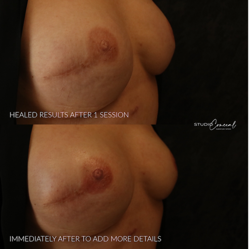 POST-MASTECTOMY2.3pg