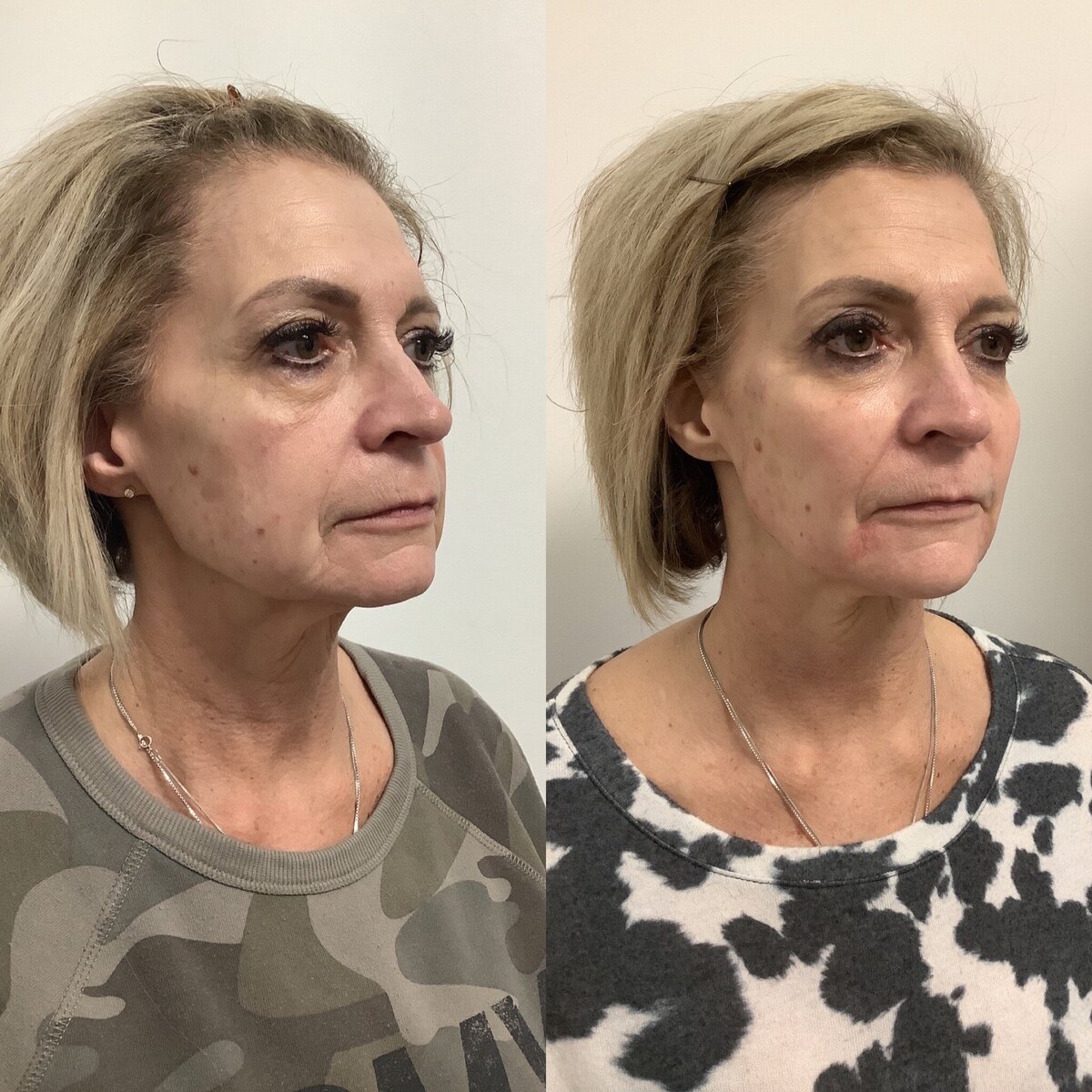 facial balancing and restoration wtih filler and tox