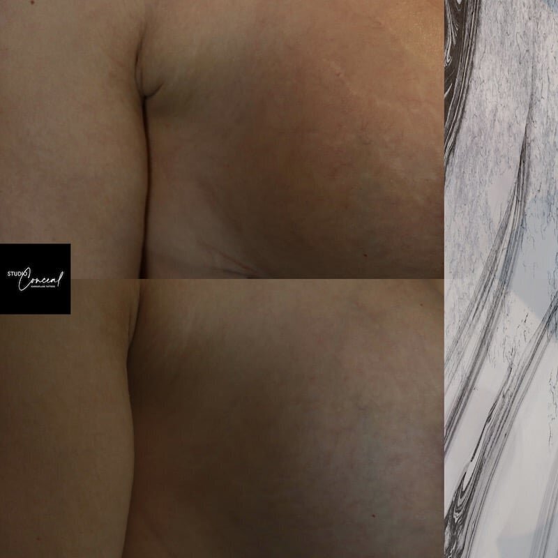 inkless-stretch-mark-revision
