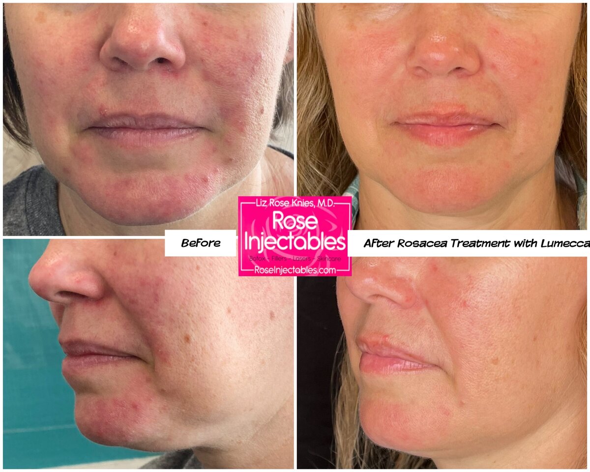 Lumecca-by-Rose-Injectables-Dark-Spot-Removal-Before-and-After-Photos-40