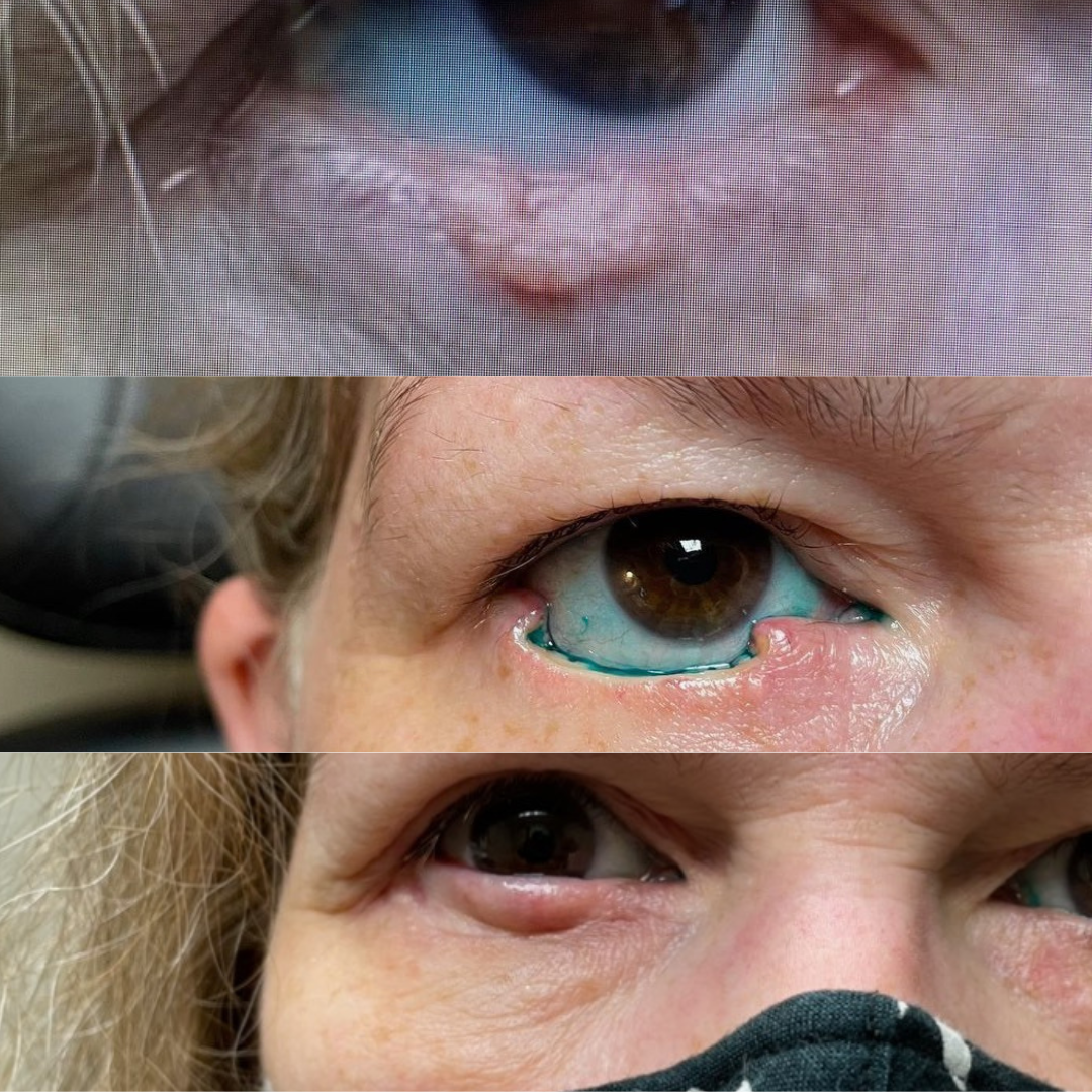 Eyelid reconstruction after skin cancer