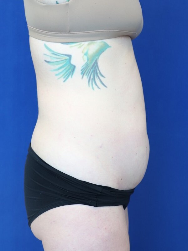 8 weeks After 1 truSculpt after