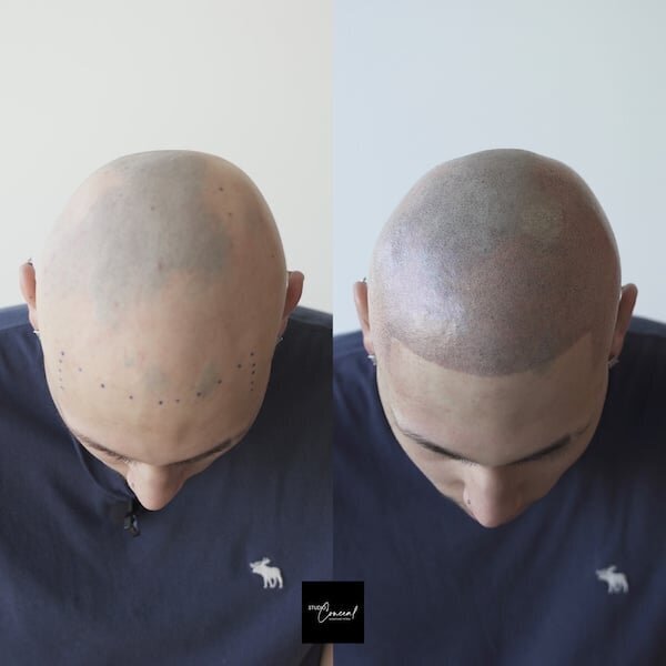 Alex-alopecia-copy
