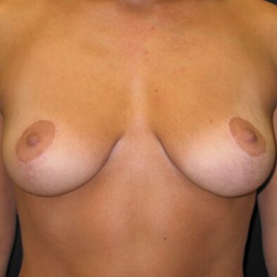 after_breast 2