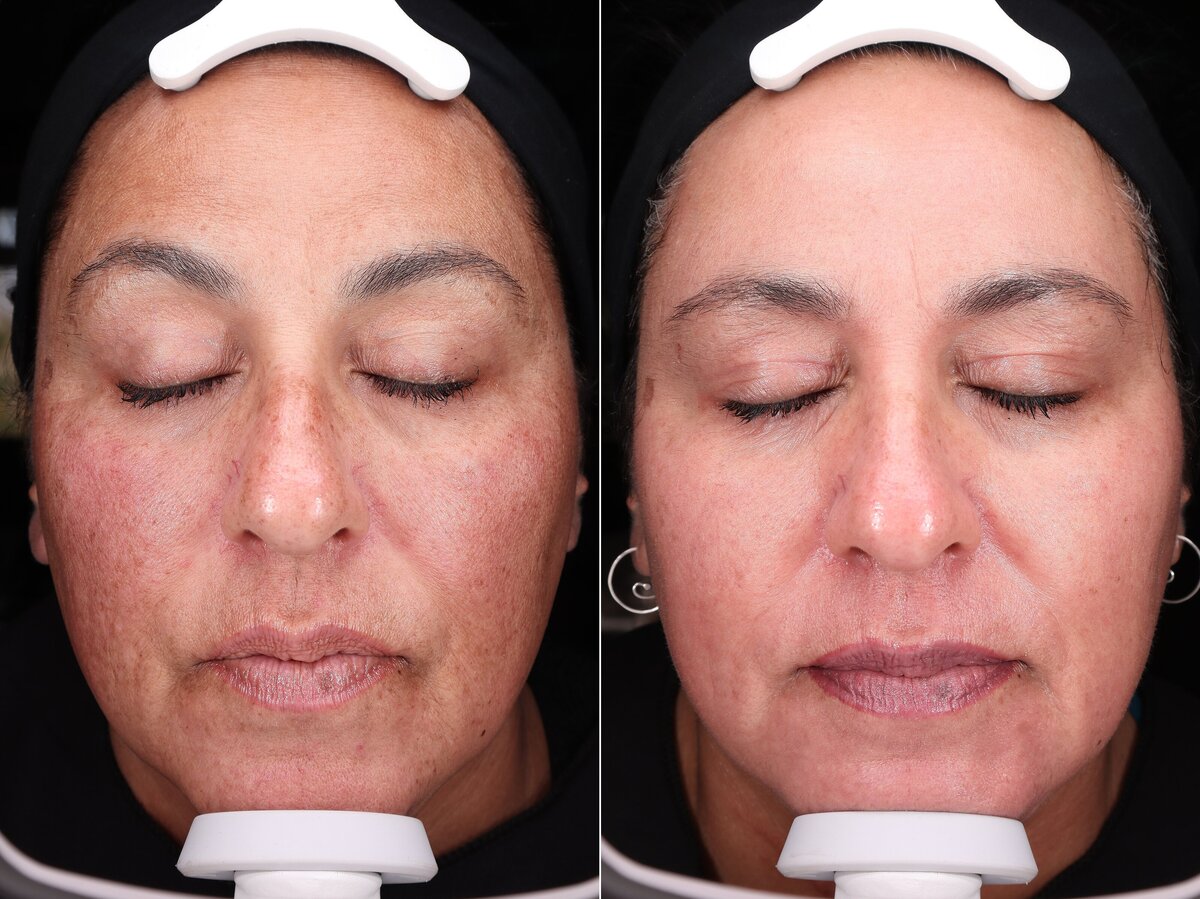 Allure AZ_hyperpigmentation-treatment-flagstaff_0036