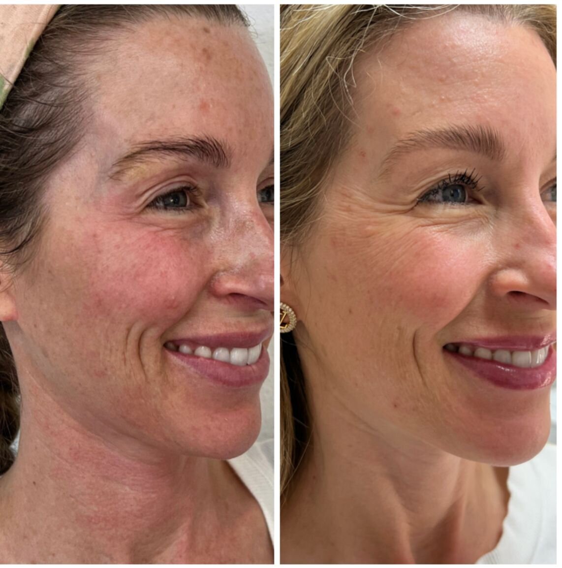 compressed-BBL-HALO-before-after-05
