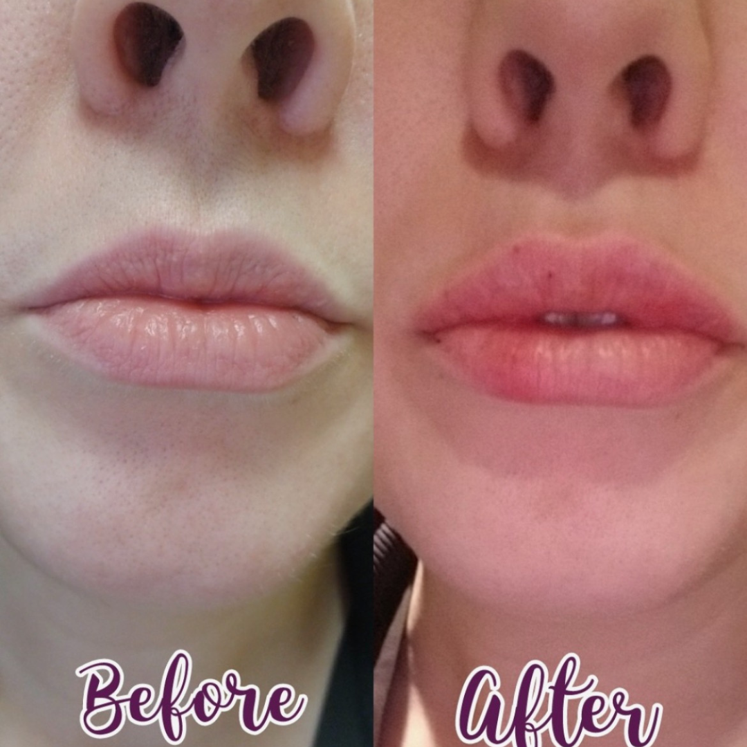 Lip enhancement with Juvederm