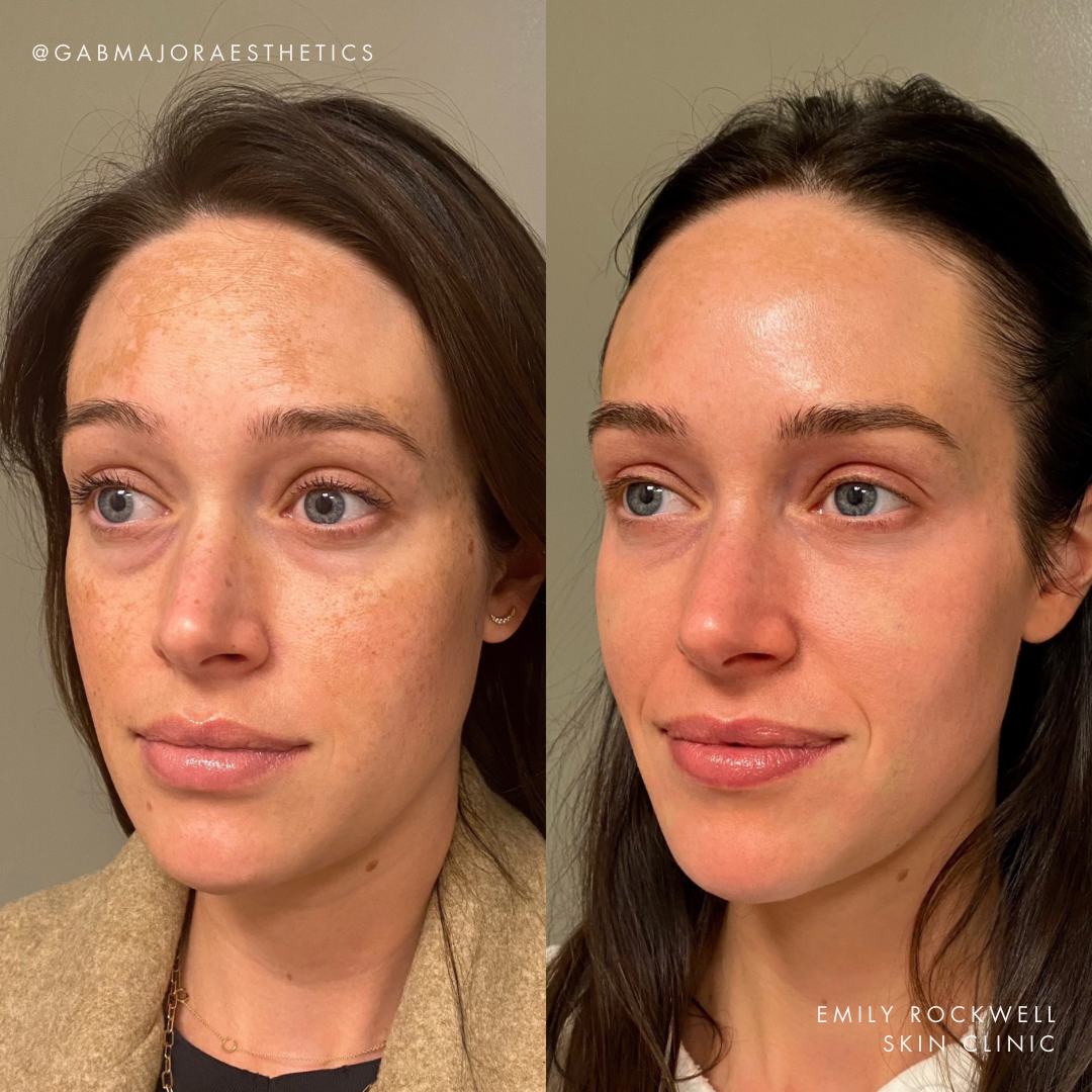 melasma patient