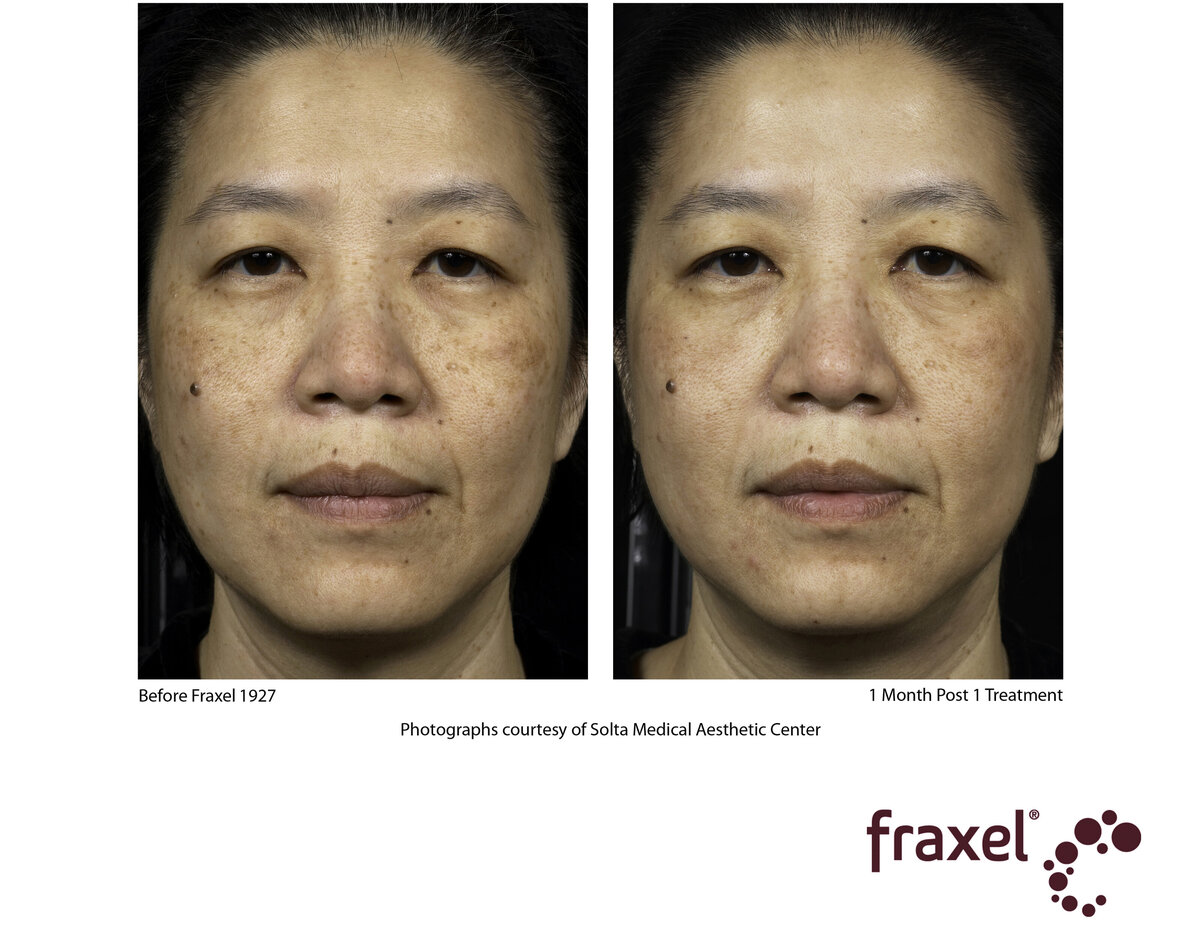 0357-Fraxel_1927_1_HiRes