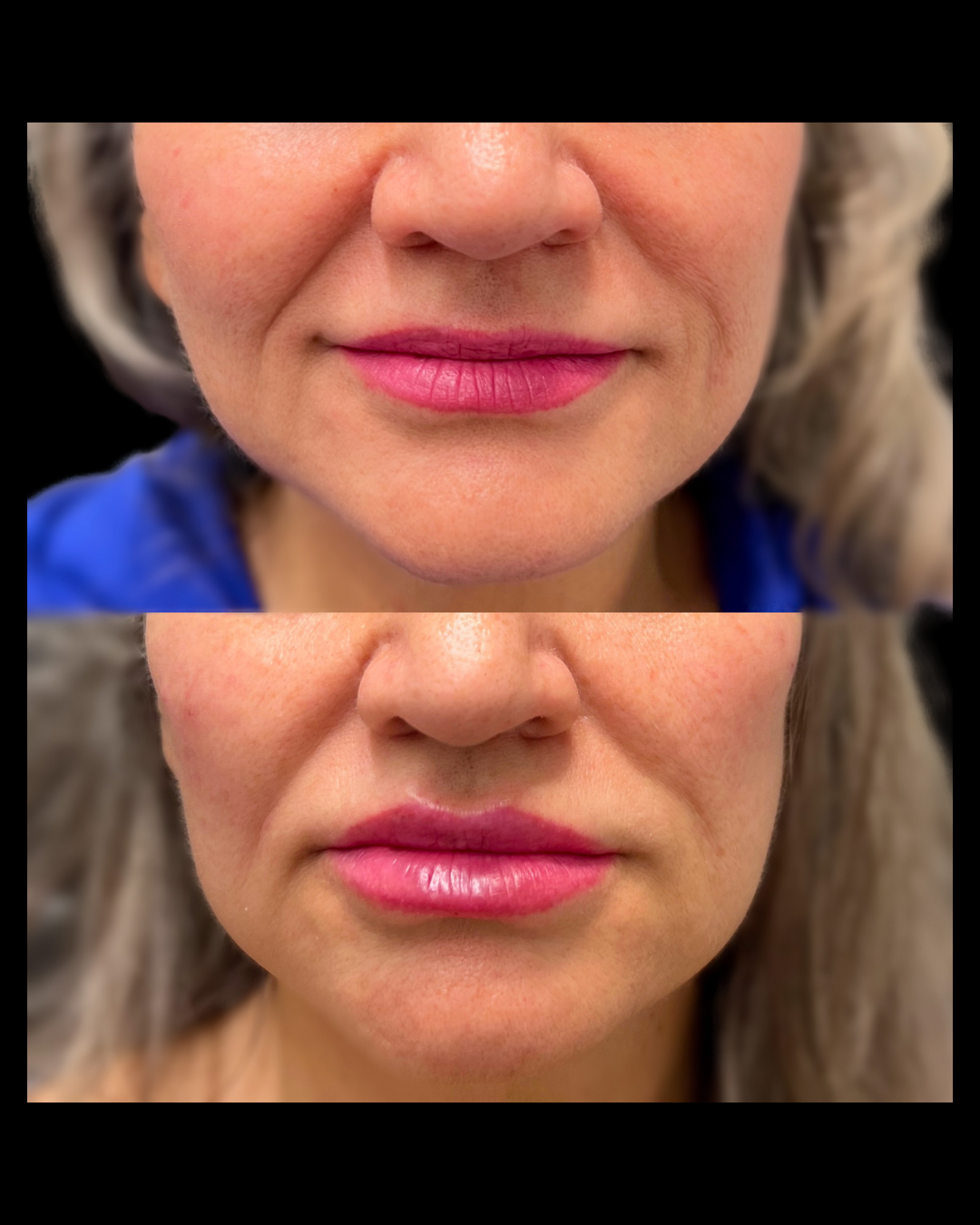 Lower face before and after showcasing Sculptra or dermal filler treatment to restore lost volume and smooth deep lines