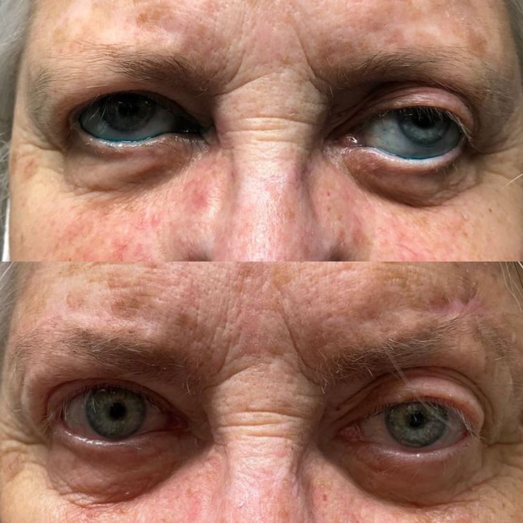 Thyroid Eye Disease. Before and after complex reconstruction