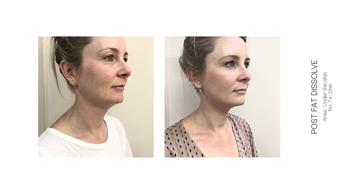 Under Chin Fat Dissolve Before and After 6