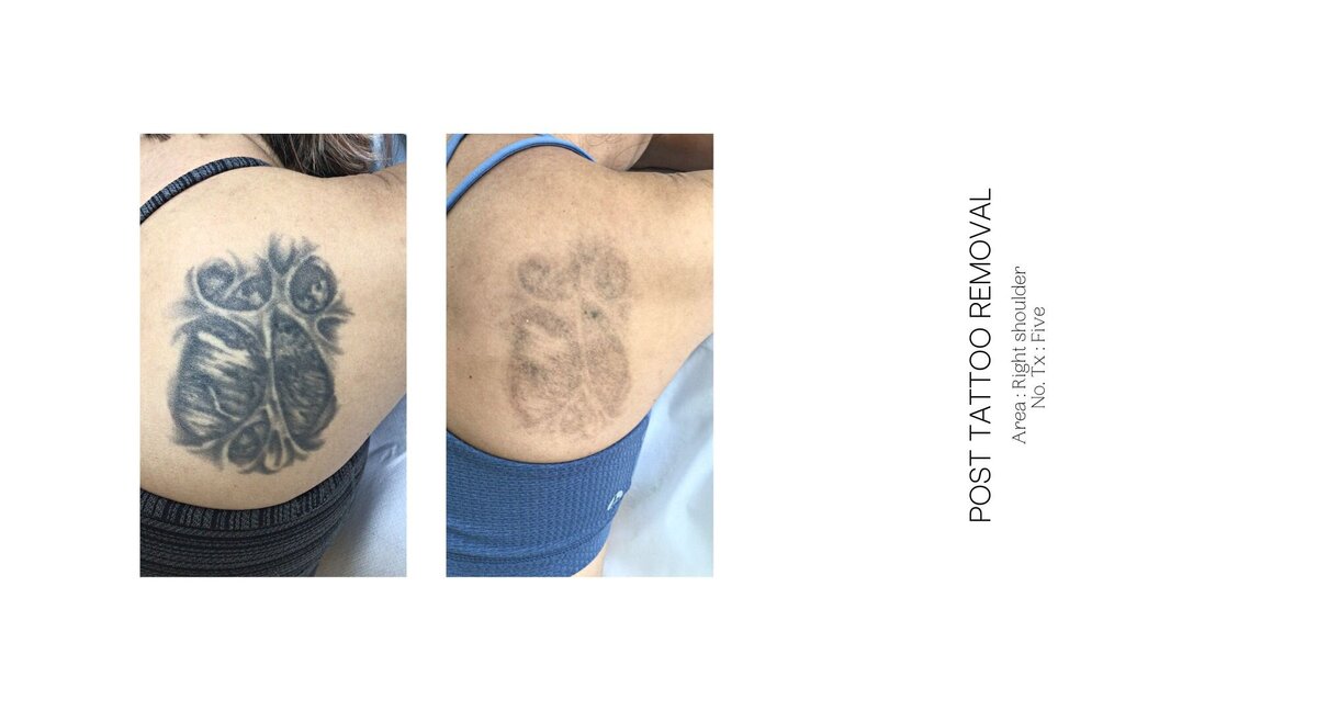 Best Tattoo Removal Before and After