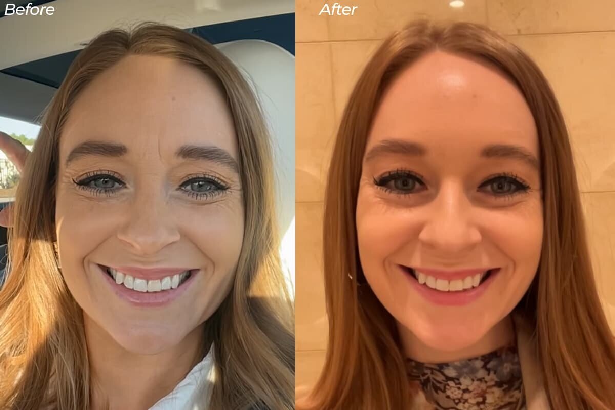 botox-BNA-2