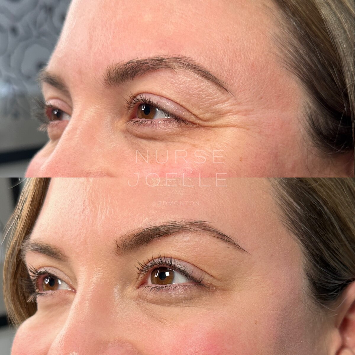 Nurse-Joelle-Botox-Before-After