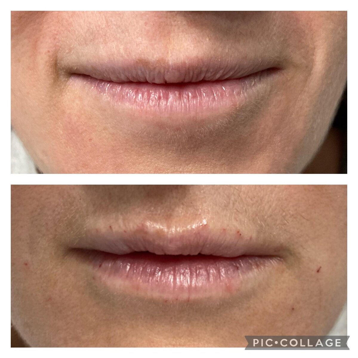 lip filler in norwich based clinic aesthetic practitioner
