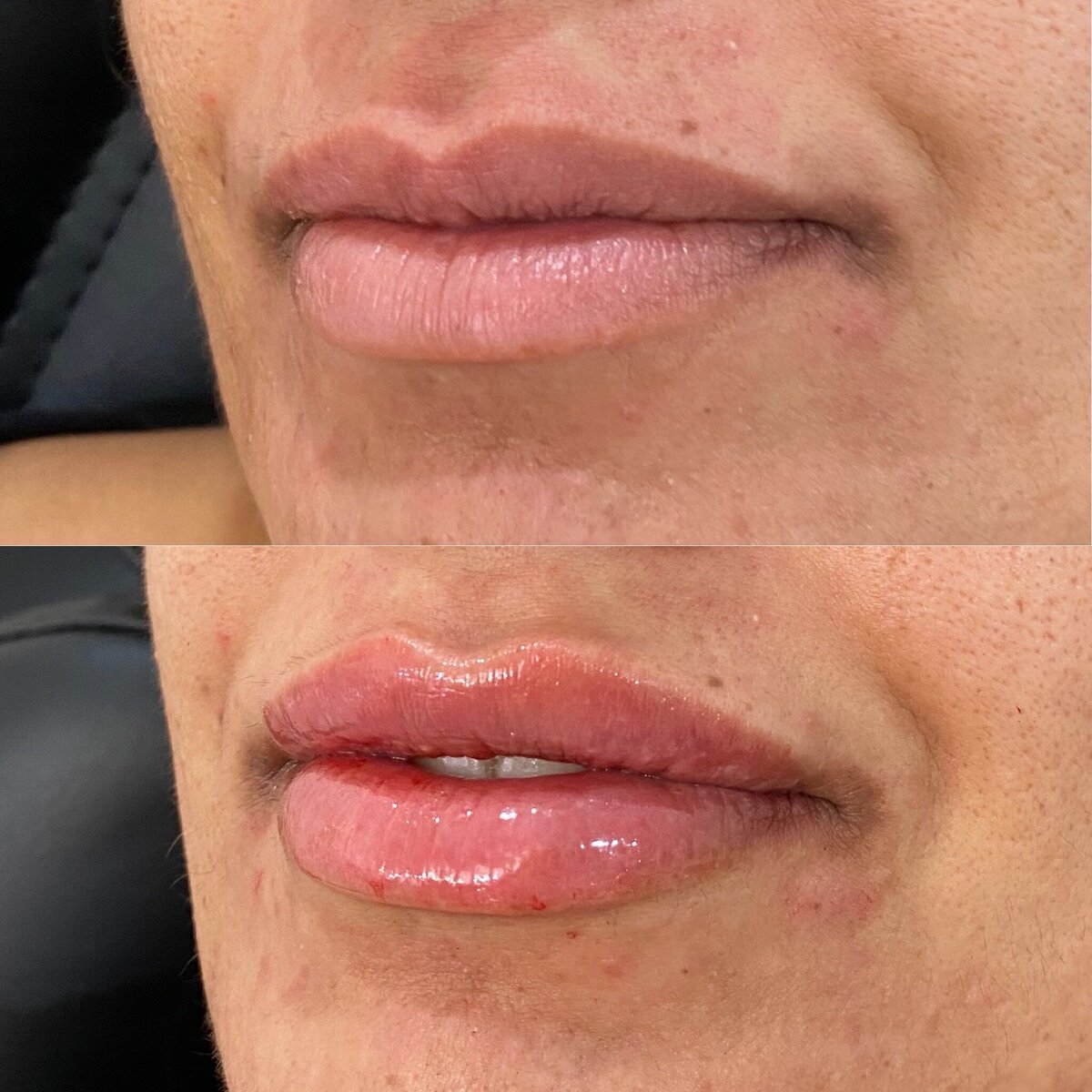BalancedBeautyBotoxWestwood14