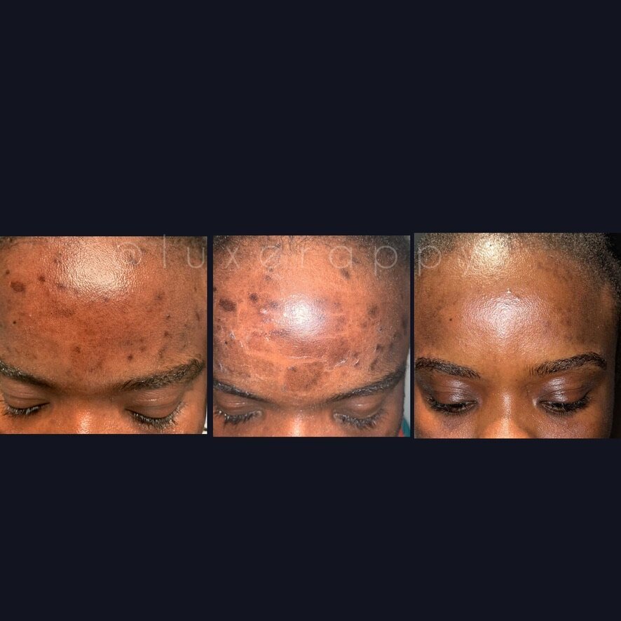 before and after a chemical peel on forehead