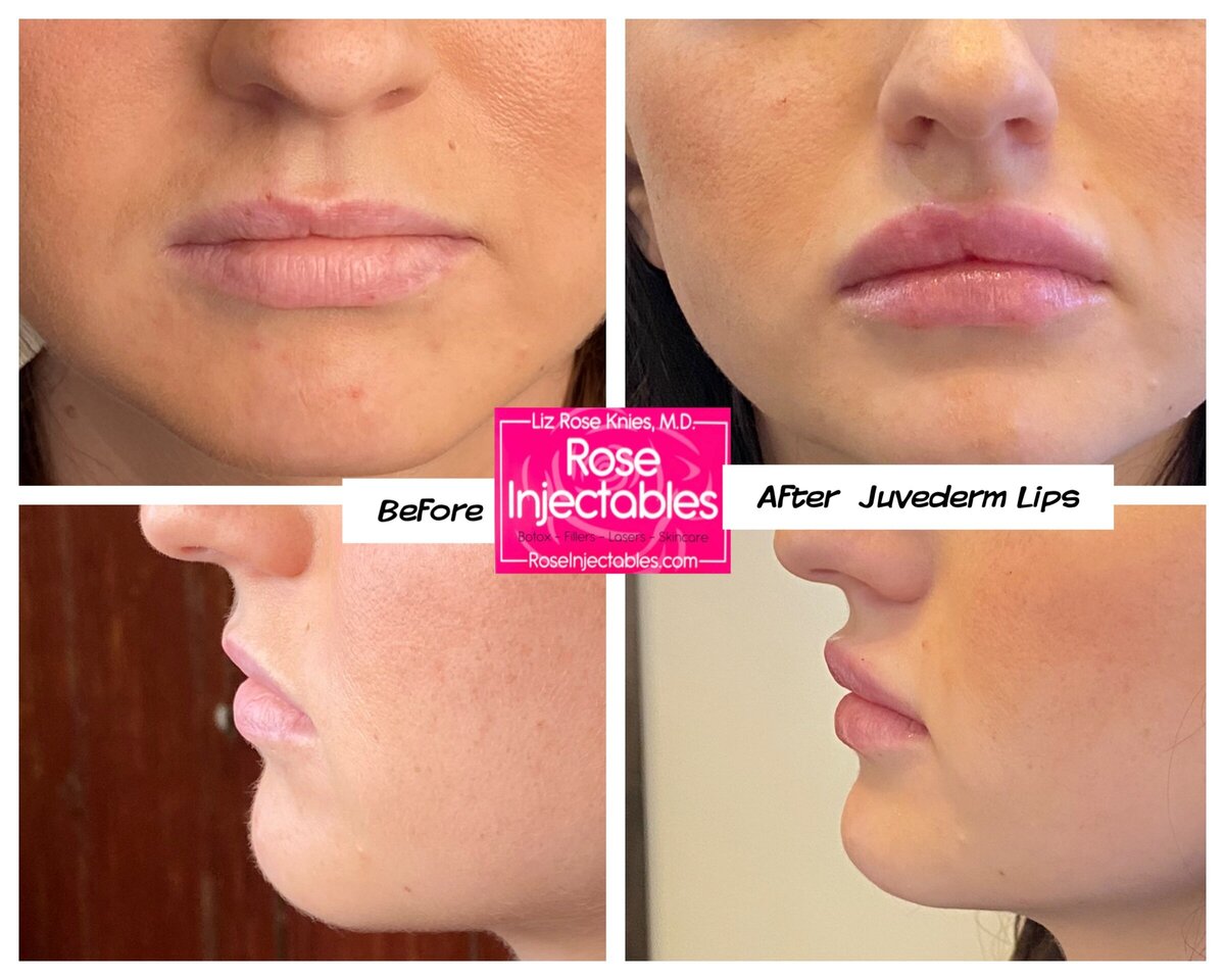 Fillers-by-Rose-Injectables-Before-and-After-Photos-40