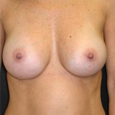 after_breast 4