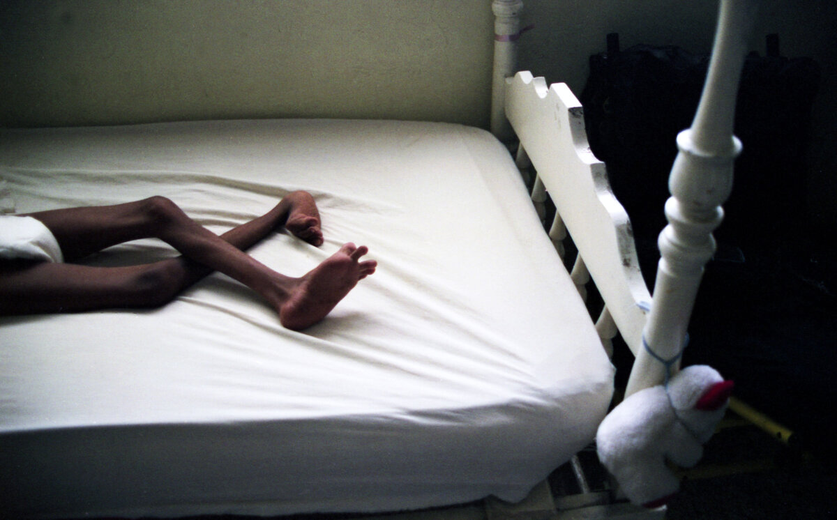 Child with physical deformity of legs. Just legs are shown on bed